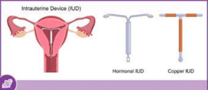 IUD Placement
