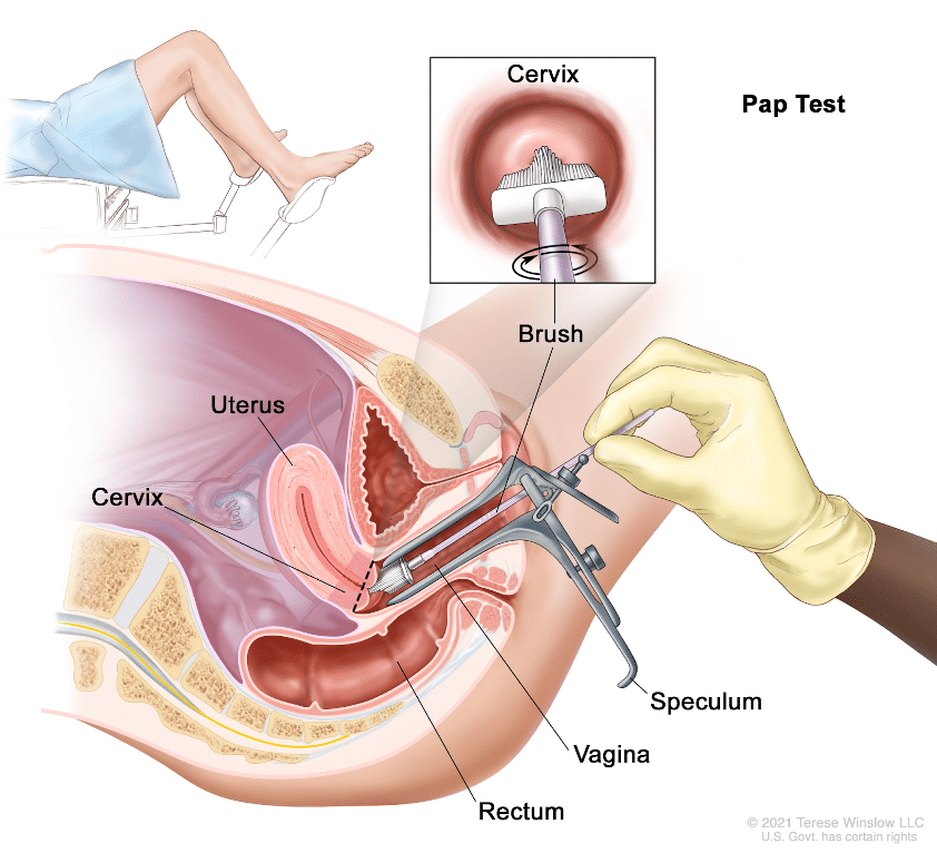 Medical diagram showing what happens during a pap smear